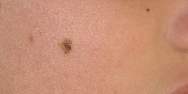 Abnormal Skin Biopsy Results