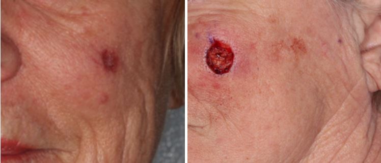Adnexal Squamous Cell Carcinoma Recurring In Parotid Skin Cancer And
