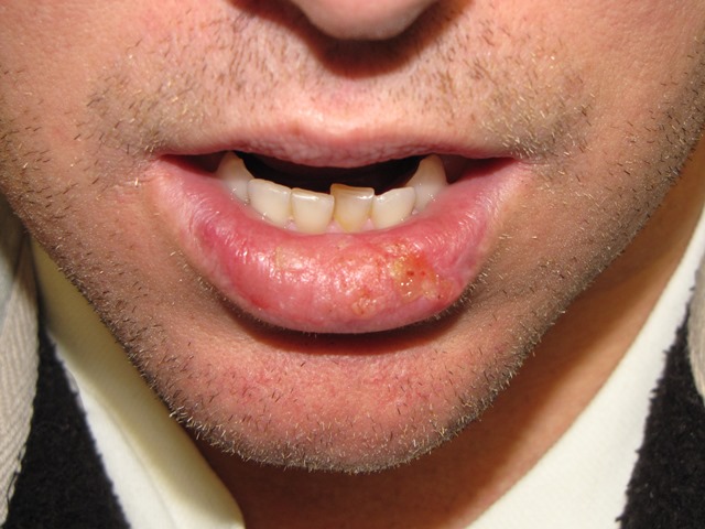 basal cell carcinoma lip