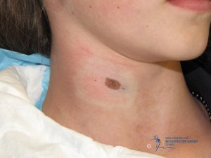 dysplastic nevus