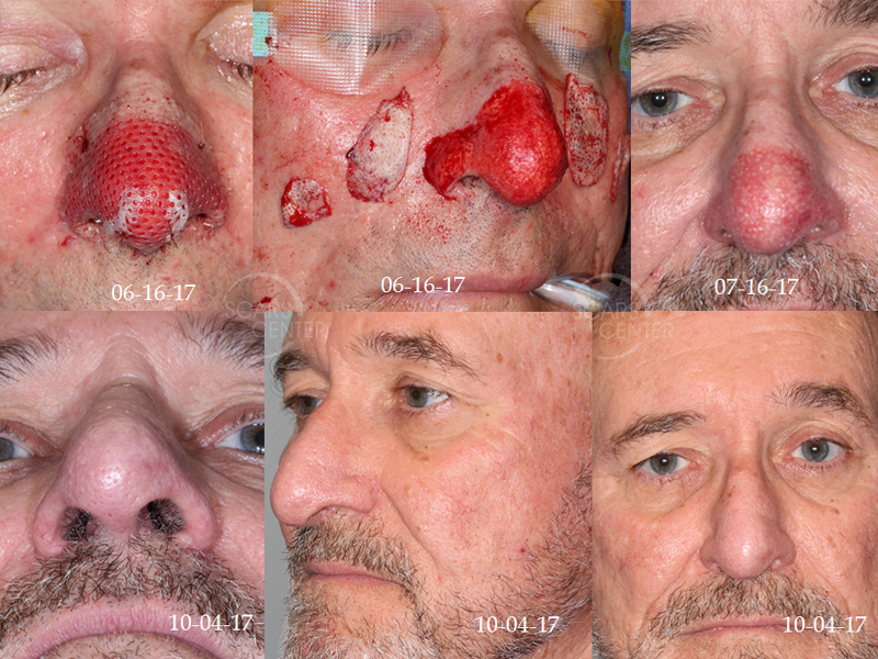 Skin-Cancer-Conference-Rhynophyma-nose-SCARS-Foundation2