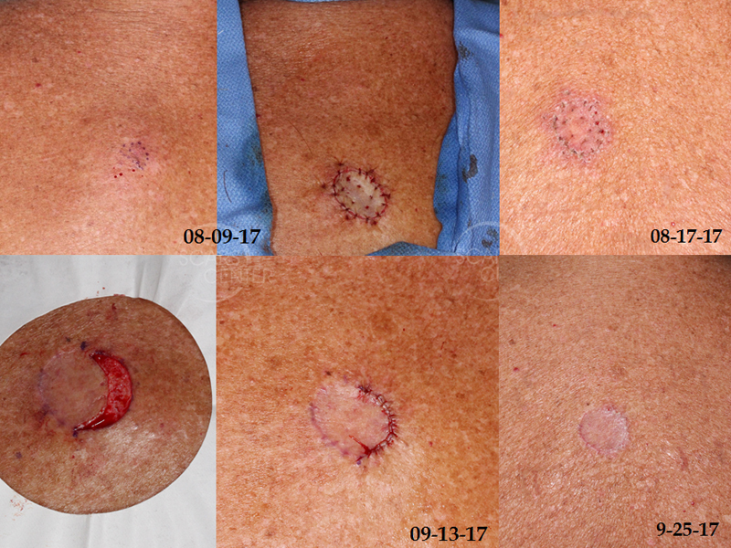 Skin-Cancer-Diagnosis-Chasing-Margins-of-Melanoma-in-Situ-of-Back-SCARS-Foundation