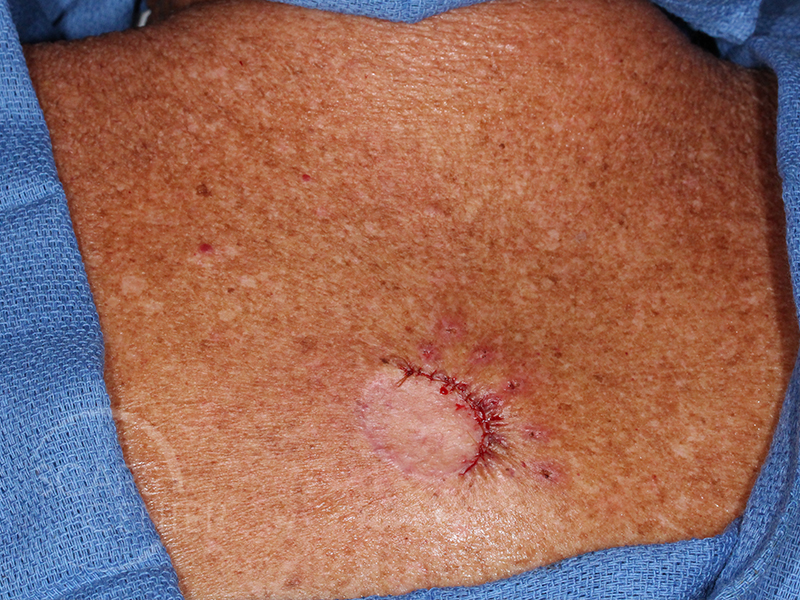 Skin-Cancer-Diagnosis-Chasing-Margins-of-Melanoma-in-Situ-of-Back-SCARS-Foundation3
