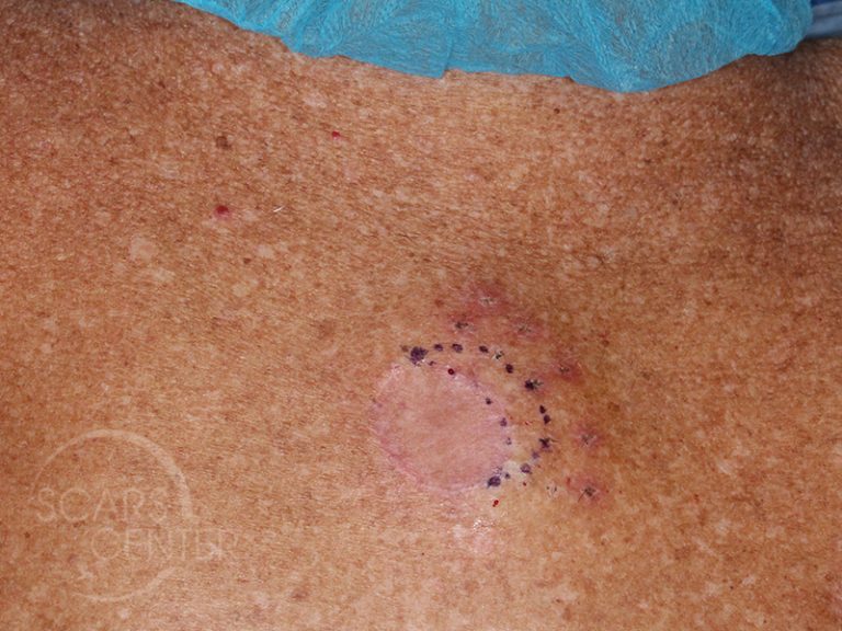 chasing-margins-of-melanoma-in-situ-of-back-skin-cancer-and