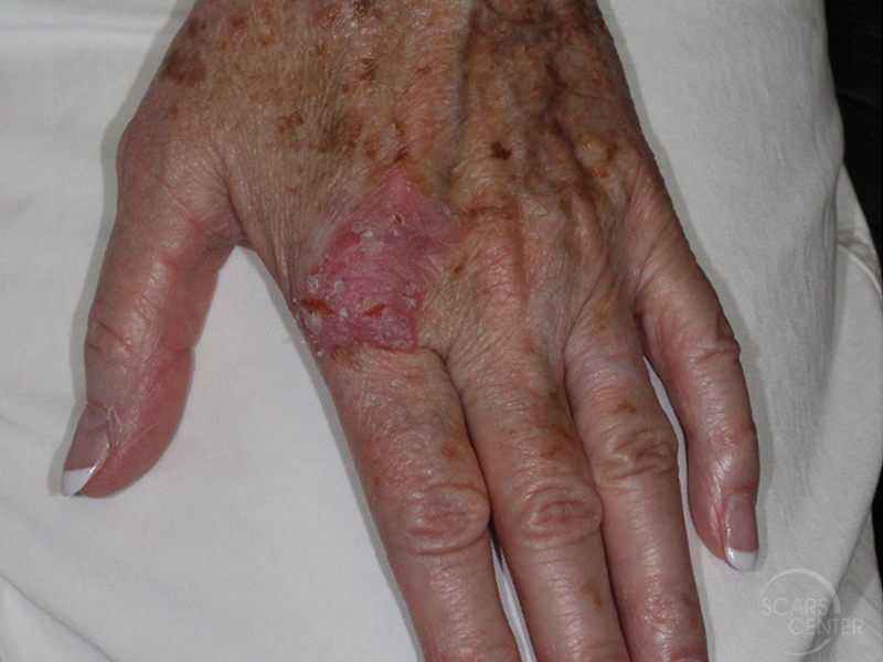 Cancer Diagnosis Hand Squamous Cell Carcinoma in Situ