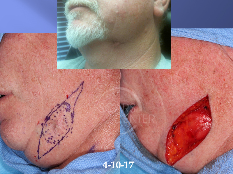 1SCARS-Center-Deep-Neck-Basal-Cell-Carcinoma-Recurrence-Skin-Cancer-Cheek (3) - Copy