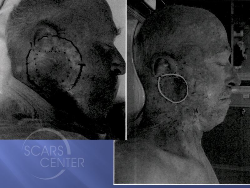1SCARS-Center-Field-Cancerization-with-basal-cell-carcinoma-skin-cancer-forehead (3)