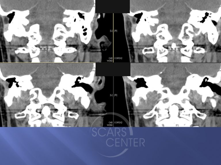 FIELD CANCERIZATION WITH BASAL CELL CARCINOMA Skin Cancer and