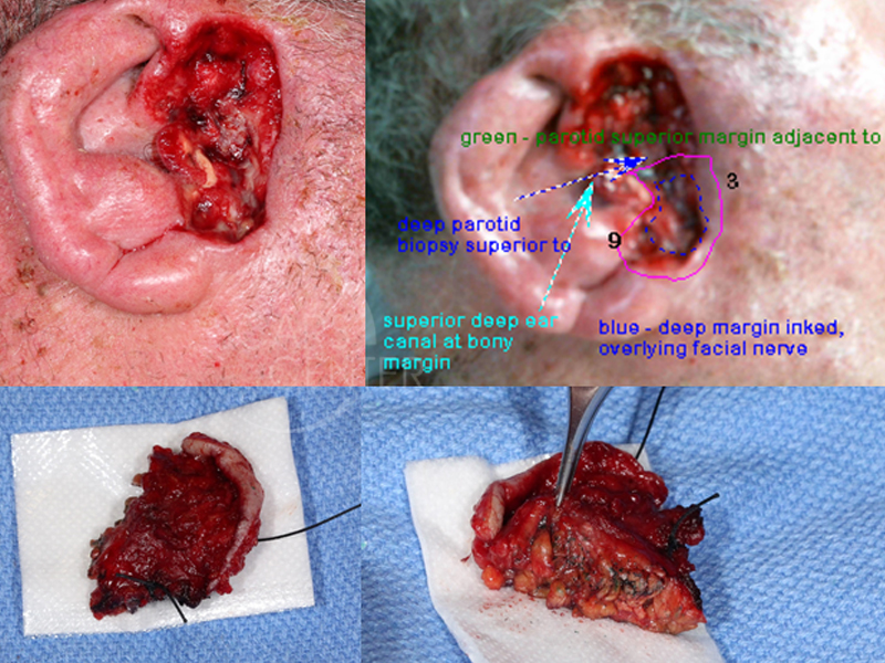 Basosquamous-Cell-Invading-Deep-Parotid-Scalp-Skin-Cancer-And-Reconstructive-Surgery-Foundation1