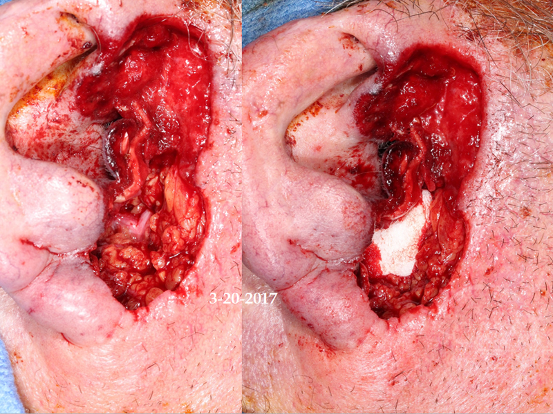 Basosquamous-Cell-Invading-Deep-Parotid-follow-up-Skin-Cancer-And-Reconstructive-Surgery-Foundation2