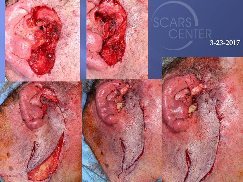 Basosquamous-Cell-Invading-Deep-Parotid-follow-up-Skin-Cancer-And-Reconstructive-Surgery-Foundation3
