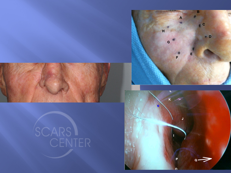 Cheek-Basal-Cell-Carcinoma-Skin-Cancer-And-Reconstructive-Surgery-Foundation1