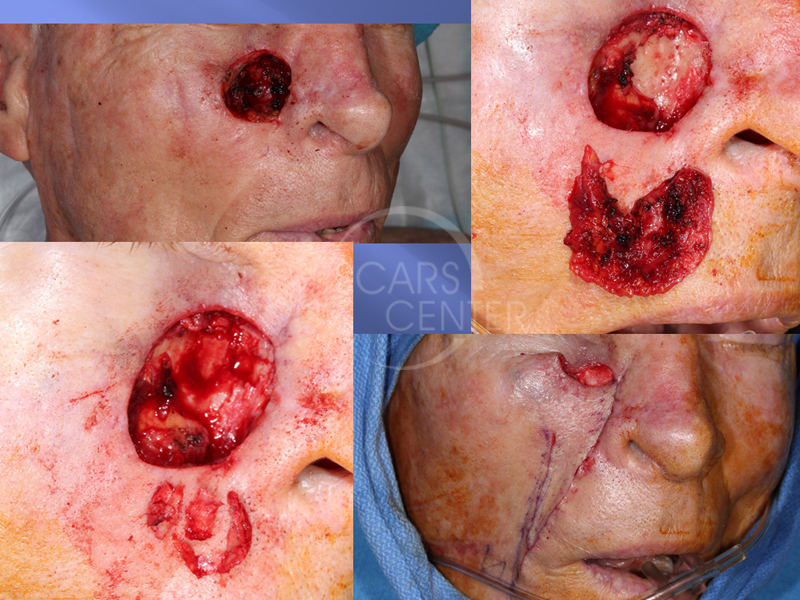 Cheek-Basal-Cell-Carcinoma-Skin-Cancer-And-Reconstructive-Surgery-Foundation2