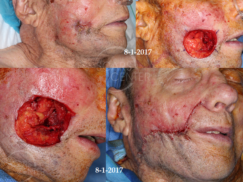 Deeply-Invasive-Squamous-Cell-Carcinoma-of-Cheek-Skin-Cancer-And-Reconstructive-Surgery-Foundation-Skin-Cancer-Conference-August-2017