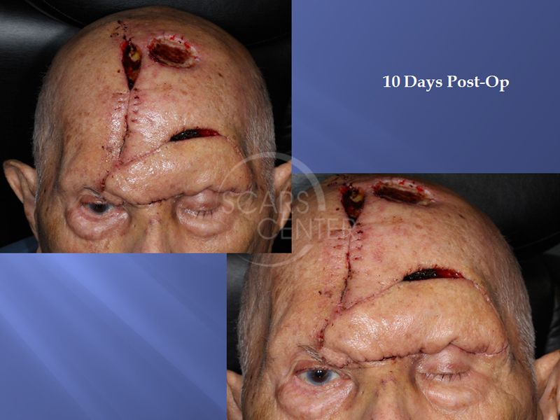 EYEBROW-AND-FOREHEAD-SQUAMOUS-CELL-CARCINOMA-Skin-Cancer-And-Reconstructive-Surgery-Foundation3