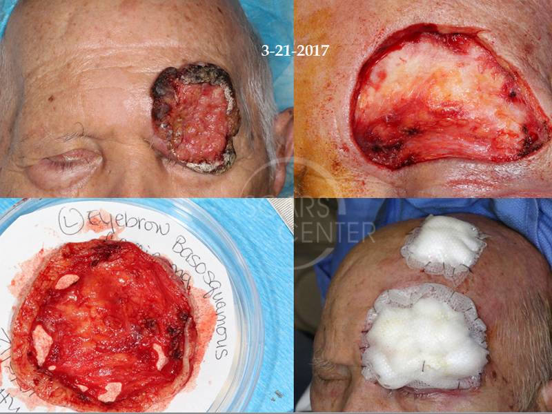 EYEBROW-AND-FOREHEAD-SQUAMOUS-CELL-CARCINOMA-Skin-Cancer-And-Reconstructive-Surgery-Foundation4