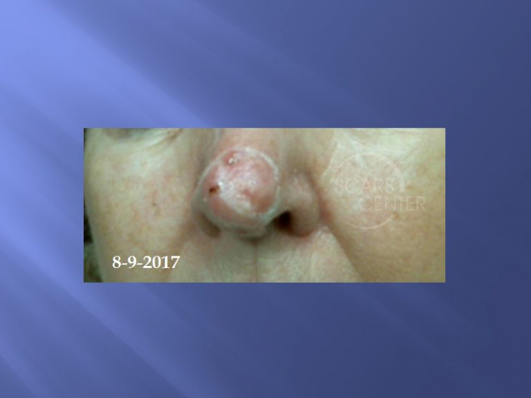 Extensive Nasal Tip Basal Cell Carcinoma Skin Cancer And Reconstructive Surgery Center