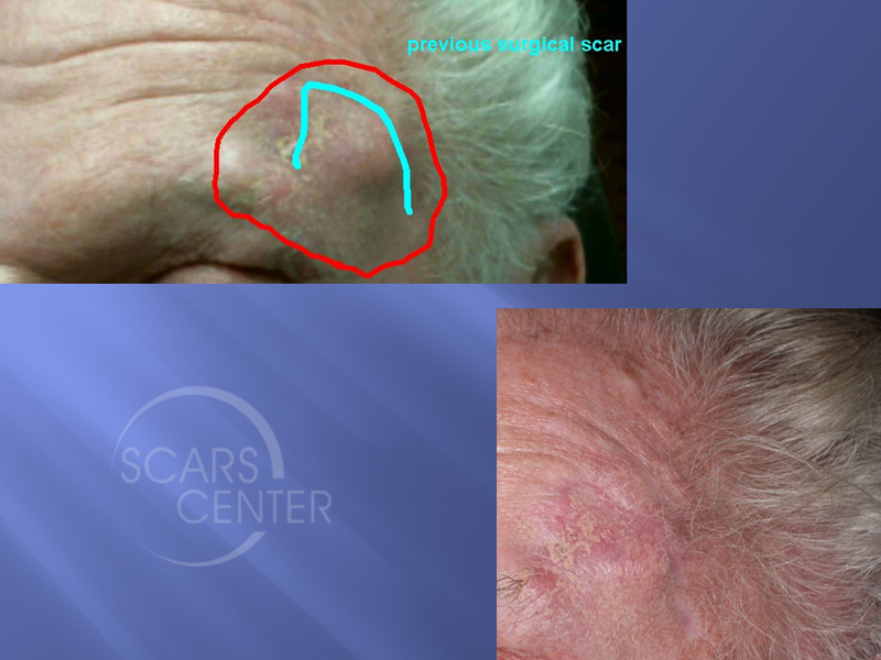 Forehead-Squamous-Cell-Carcinoma-Skin-Cancer-And-Reconstructive-Surgery-Foundation1