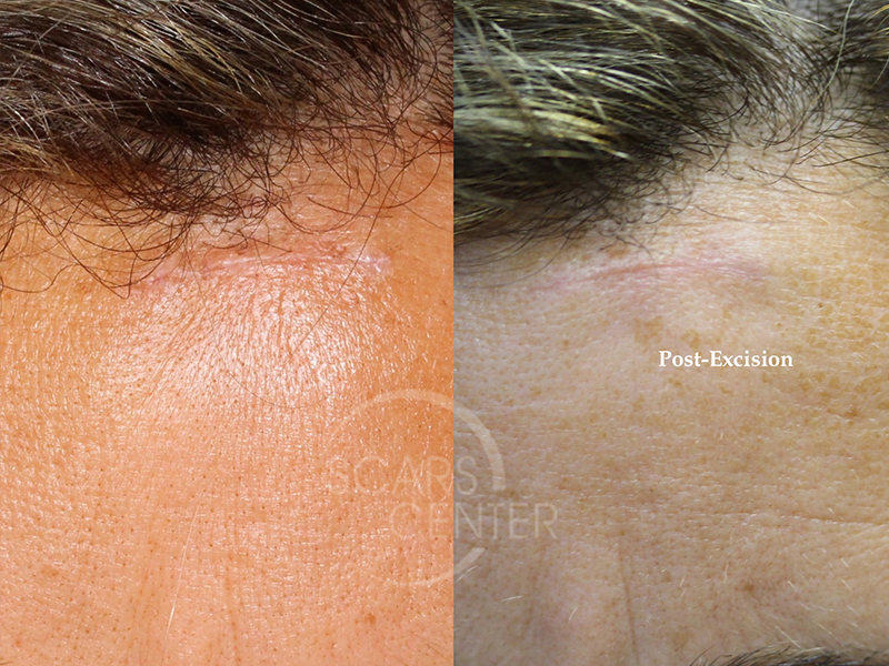 Foreign-Body-Granuloma-of-Forehead-Skin-Cancer-And-Reconstructive-Surgery-Foundation-1