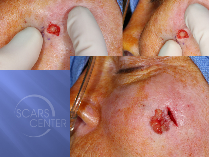 Left-Cheek-Nodule-Skin-Cancer-And-Reconstructive-Surgery-Foundation1