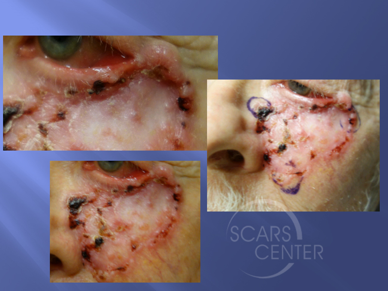 Lower-Lid-Carcinoma-Skin-Cancer-And-Reconstructive-Surgery-Foundation1