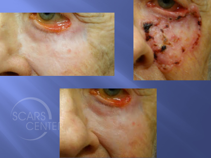 Lower-Lid-Carcinoma-Skin-Cancer-And-Reconstructive-Surgery-Foundation2