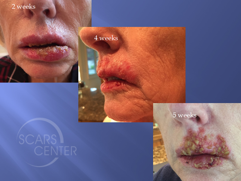 BCC Treatments for Left Upper Lip