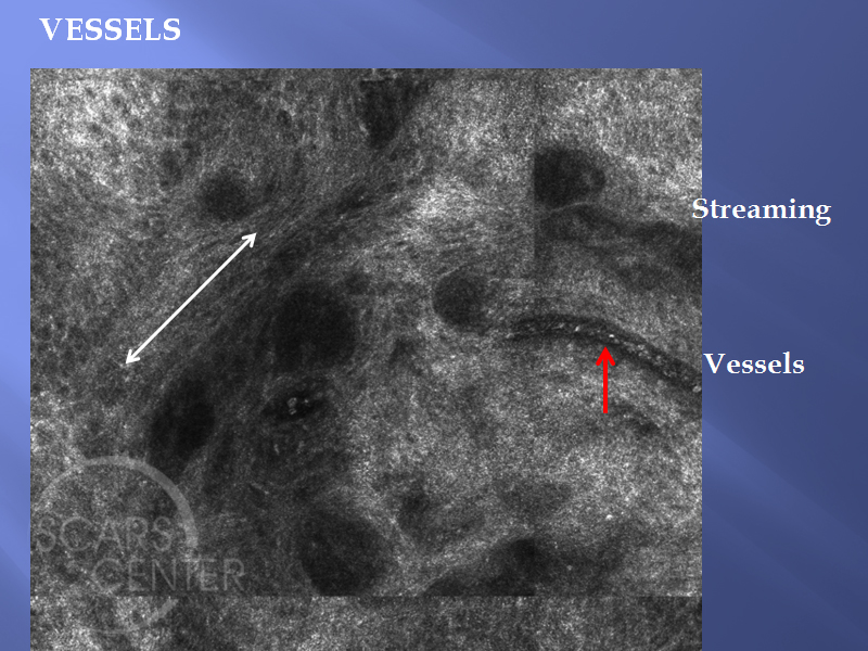 Mapping-BCC-with-Confocal-Microscopy-Skin-Cancer-And-Reconstructive-Surgery-Foundation7