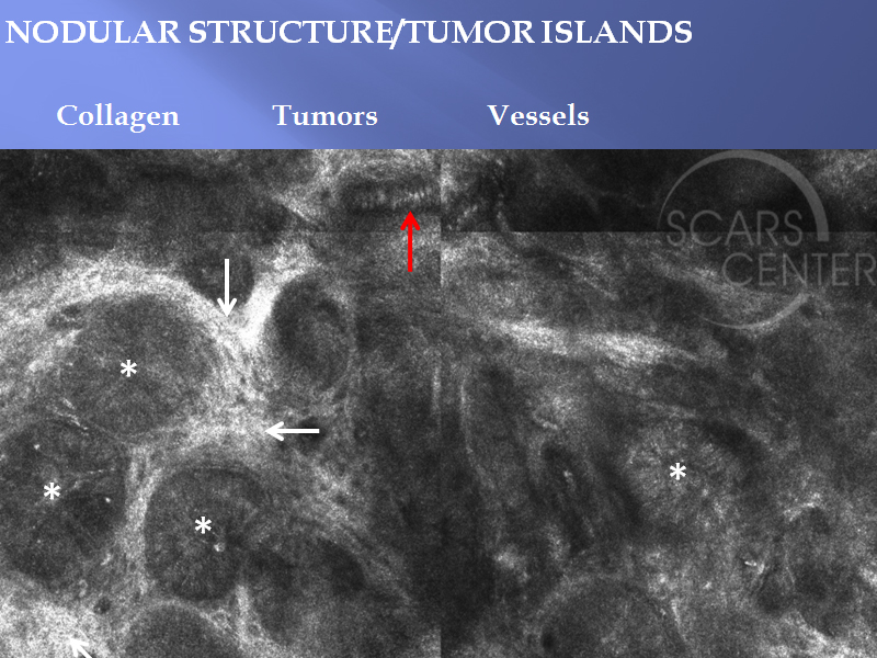 Nodular Basal Cell Carcinoma of Skin