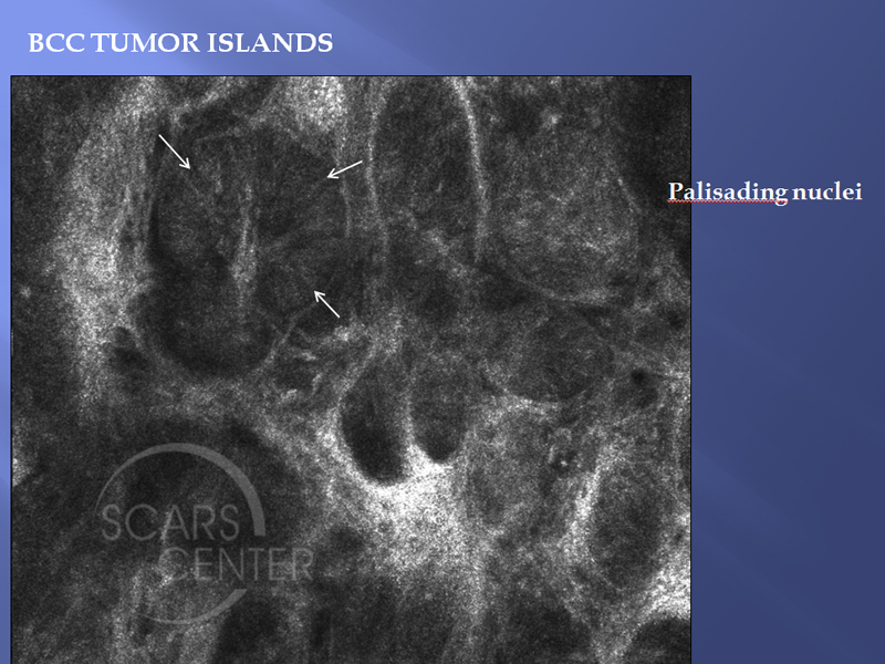 Bcc Tumor Islands Map