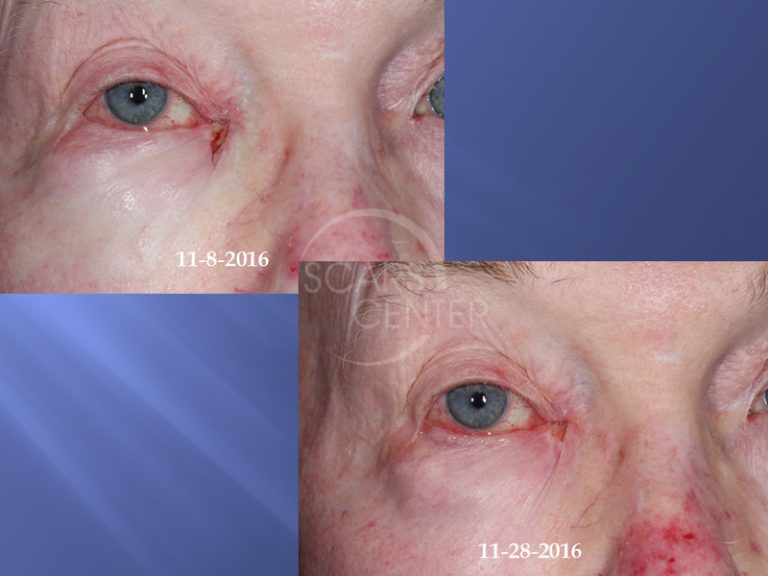 Medial Canthus Basal Cell Carcinoma Follow Up Skin Cancer And Reconstructive Surgery Center 7283