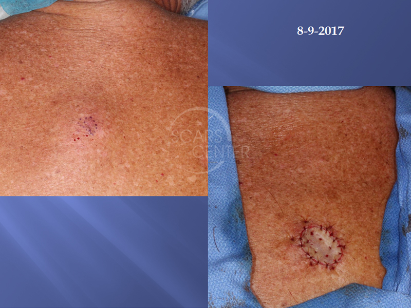 Melanoma Removal