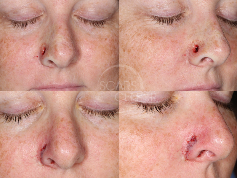 Reconstructive-Case-Alar-Island-Combination-Flap-Skin-Cancer-And-Reconstructive-Surgery-Foundation1
