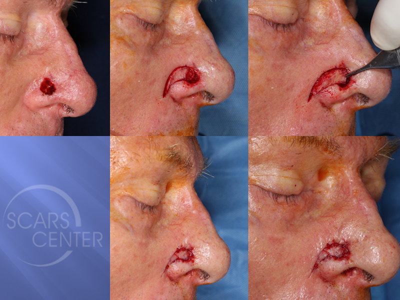 Reconstructive-Case-Alar-Island-Combination-Flap-Skin-Cancer-And-Reconstructive-Surgery-Foundation2