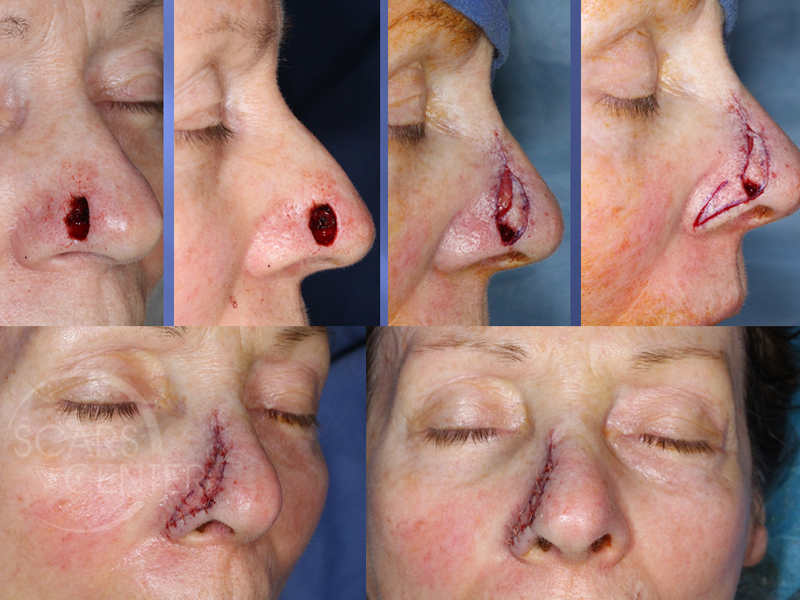 Reconstructive-Case-Alar-Island-Combination-Flap-Skin-Cancer-And-Reconstructive-Surgery-Foundation3