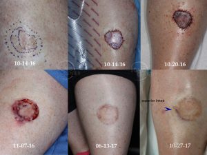 Recurrent-Melanoma-In-Situ-of-Leg-Imaging-Guided-Excision-SCARS-Foundation.1