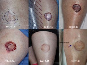 How Skin Cancer Appears on Legs