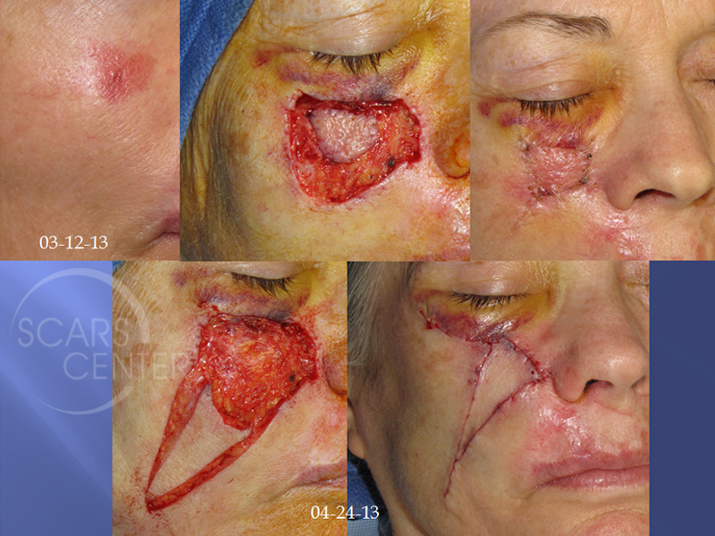 Recurrent-Melanoma-SCARS-Center-Case-2-Skin-Cancer-And-Reconstructive-Surgery-Center-Orange-County2