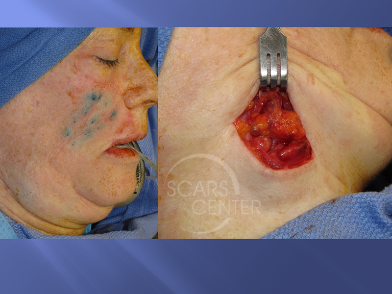 Recurrent-Melanoma-SCARS-Center-Case-2-Skin-Cancer-And-Reconstructive-Surgery-Center-Orange-County3