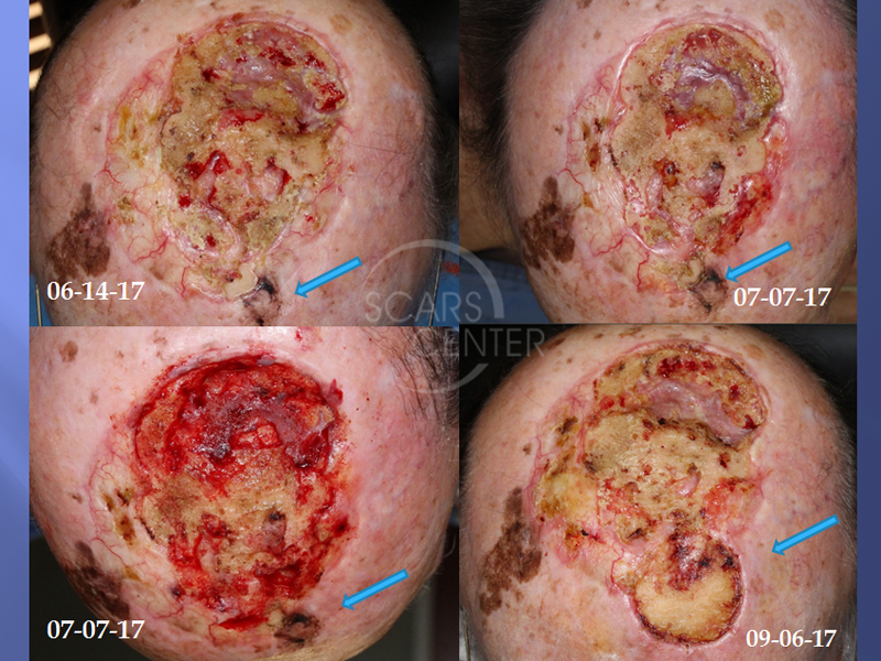 Recurrent-Scalp-Melanoma-SCARS-Center-Case-1-Skin-Cancer-And-Reconstructive-Surgery-Center-Orange-County