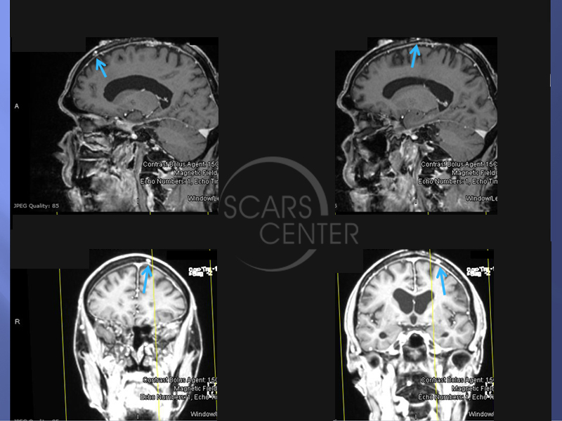 Recurrent-Scalp-Melanoma-SCARS-Center-Case-1-Skin-Cancer-And-Reconstructive-Surgery-Center-Orange-County2.1