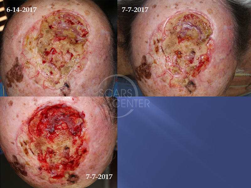 Radiation Therapy Archives - Page 2 of 2 - Skin Cancer and Reconstructive  Surgery Center