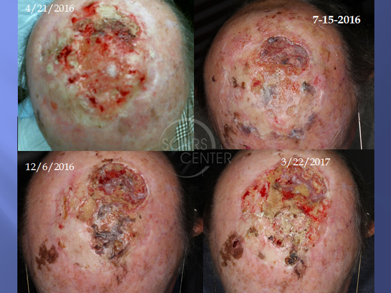 melanoma scalp