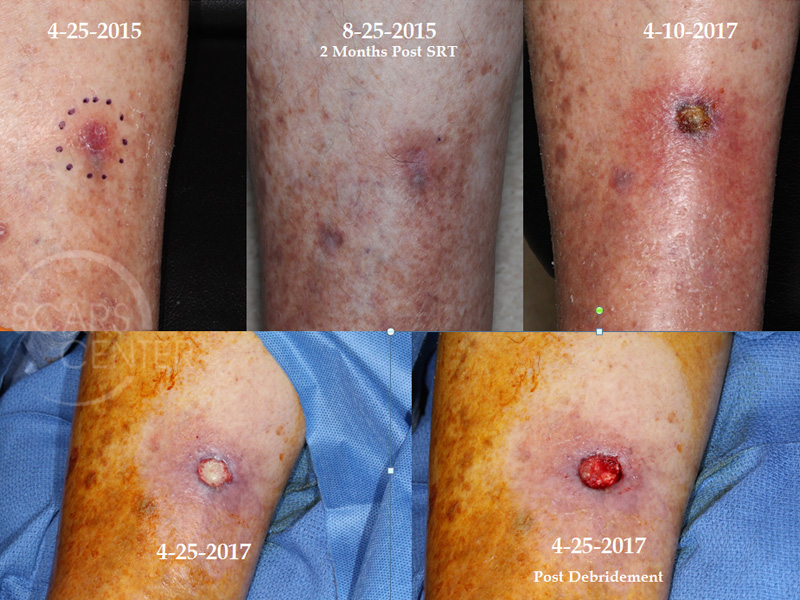 symptoms of skin cancer on leg