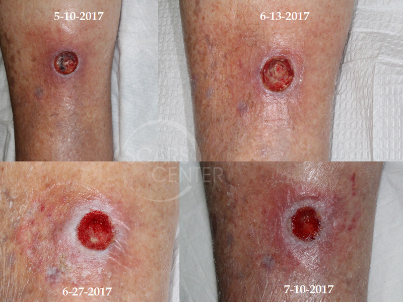 SCARS-Center-Lower-Leg-Radiation-Ulcer-Skin-Cancer-Leg1