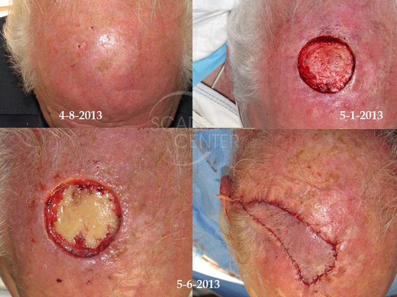 SCARS-Center-Metastatic-Squamous-Cell-Carcinoma-of-Scalp-skin-cancer-scalp