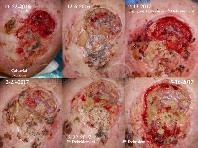 SCARS-Center-Osteoradionecrosis-of-Skull-skin-cancer-scalp-2