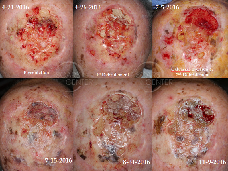 SCARS-Center-Osteoradionecrosis-of-Skull-skin-cancer-scalp