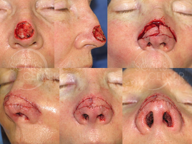 SCARS-Center-Reconstructive-Cases-Bilateral-Nasal-Island-Flaps-for-Large-Nasal-Defects-skin-cancer-nose-2.1