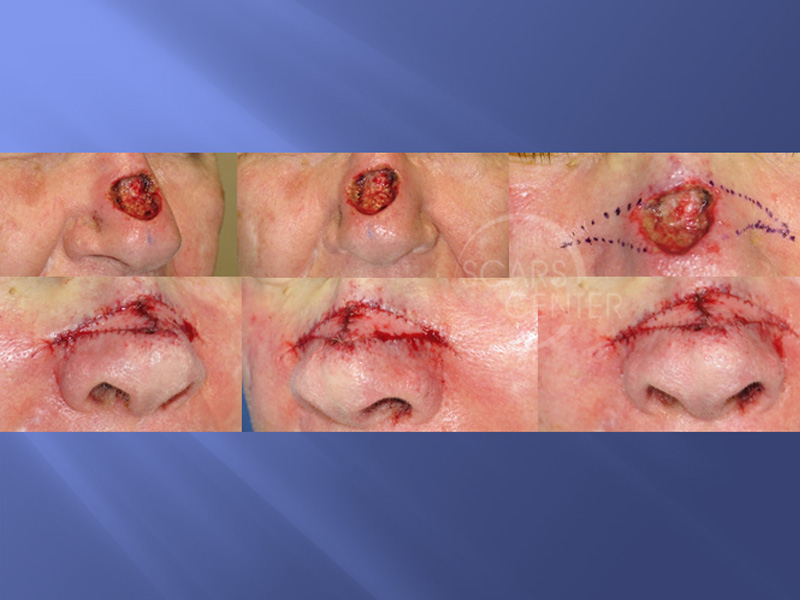 SCARS-Center-Reconstructive-Cases-Bilateral-Nasal-Island-Flaps-for-Large-Nasal-Defects-skin-cancer-nose-2